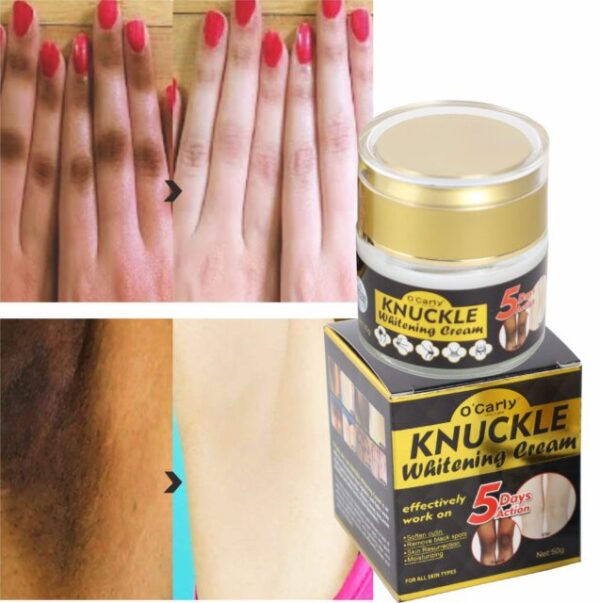 Best Whitening Cream Dark Knuckles Removal