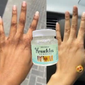 "Knuckle Removal: Say goodbye to uneven skin tone with our targeted solution. Smooth, flawless skin awaits!"