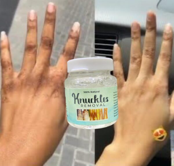 "Knuckle Removal: Say goodbye to uneven skin tone with our targeted solution. Smooth, flawless skin awaits!"